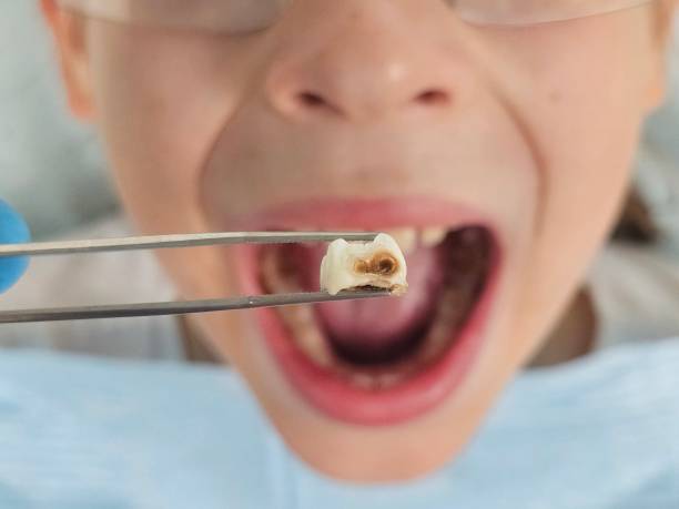 Best Dentist for Tooth Abscess  in Lake Cherokee, TX